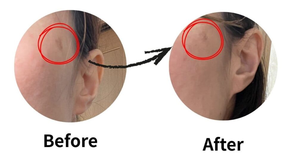 シミのbefore after写真